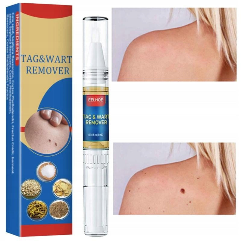 Sredstvo za uklanjanje mladeža i bradavica 1 + 1